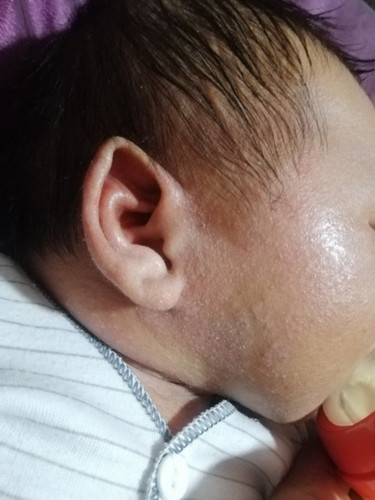 Ruam panas atau eczema?