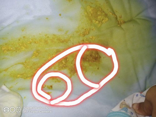 ขอสอบถามค่ะ น้องถ่ายวันนึงหลายรอบ พถ่ายมีมูก พาไปหาหมอ หมอบอกลำไส้อักเสบ ให้ยาฆ่าเชื้อมากิน7วันกับเก