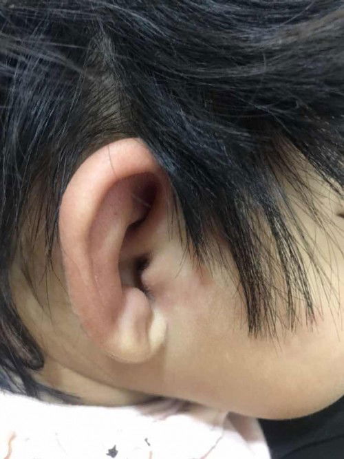 Telinga bayi digigit semut