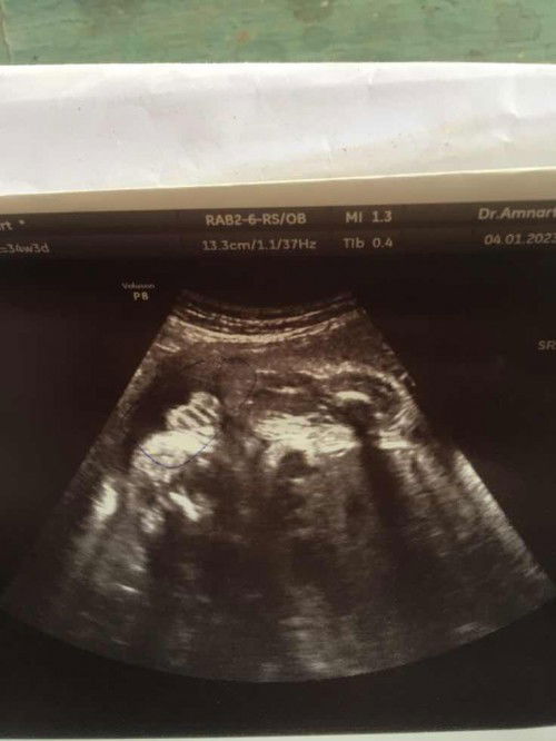 หมอบอกว่าได้ลูกสาวคะ ตรงที่หมอวงปากกาเป็นเพศน้อง ดูยังไงคะ ทำไมเรามองเป็นไข่ 😅😅