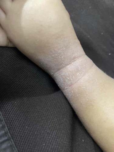 แม่ๆบ้านไหนพอทราบไหมค่ะข้อเท้าลูกเป็นลอกๆแห้ง เป็นตอน 3 เดือน