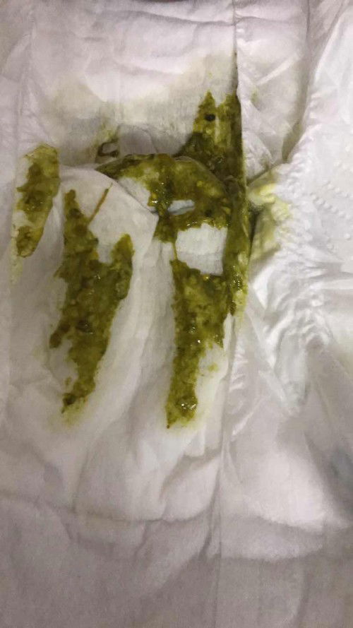 ขออนุญาตที่ภาพไม่สุภาพนะคะ น้อง 1เดือน12วัน ทานนมแม่อึเป็นสีเขียวแบบนี้ปกติมั้ยค่ะมีบ้านไหนมีประสบการณ์มั้ยค่ะเป็นแม่มือใหม่ด้วยค่ะ