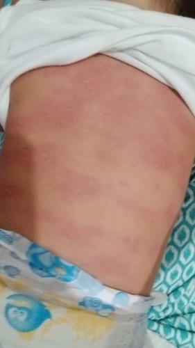 Rashes po kaya to?