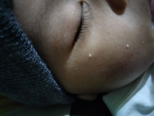 Seputar bintik putih pada wajah bayi