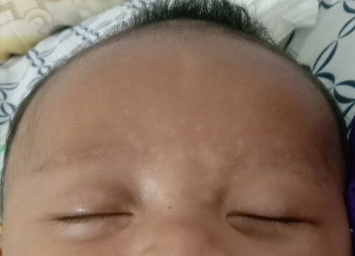 Putih2 pada jidat(kya panu)