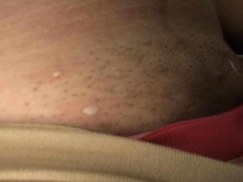 Blisters?