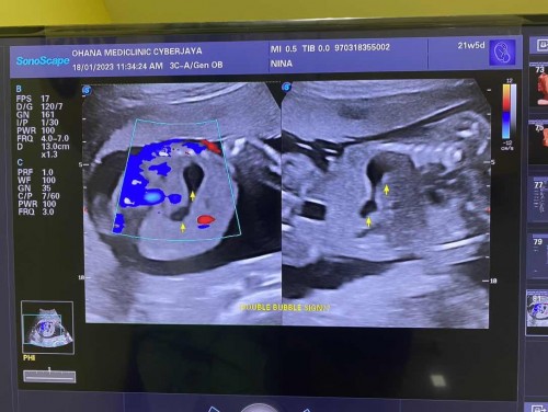 Detail scan baby usus mengelembung