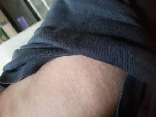 Beruntus gatal seluruh badan