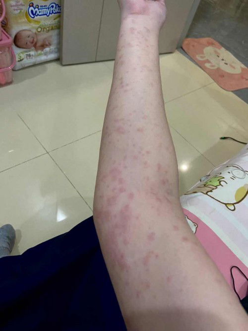 ขึ้นผื่นแดงขณะตั้งครรถ์