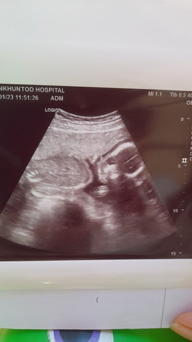 อัลตร้าซาวด์ตัวเล็ก😅