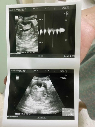 13 วีค น้องตัวเล็กไปมั้ยคะ
