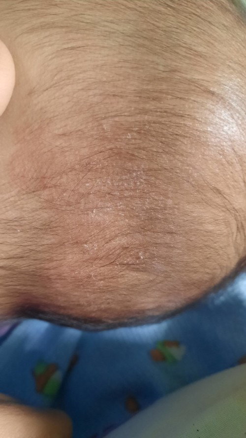Kepala bayi 6 bulan gatal