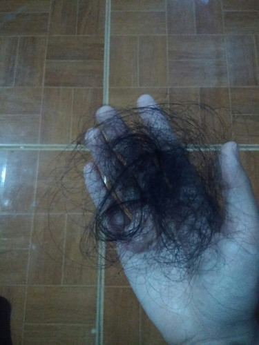 หลังคลอดผมร่วงหนักมาก