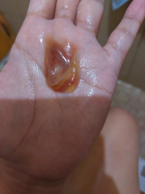 Menstruation or Implantation bleeding