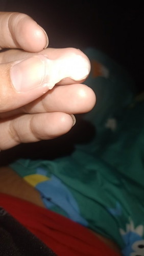 มีน้ำใสๆและมูกออกมา