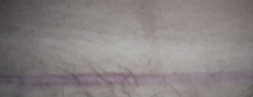 bekas operasi caesar