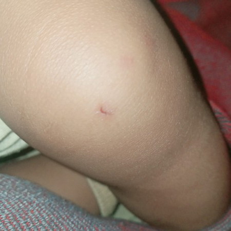 Rat Bite 7 months old