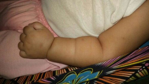 Bekas gigitan nyamuk