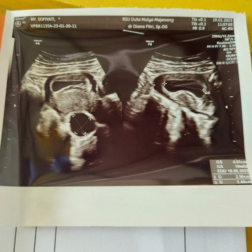 USG kantung janin lebih tua dibanding hpht