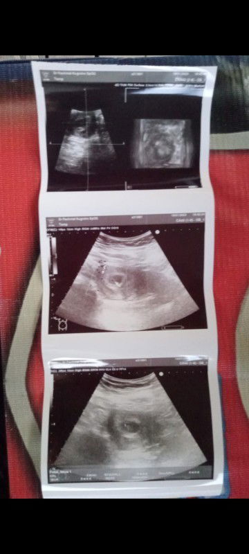 USG usia di hasil USG 5minggu 6hari