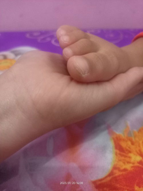 Kulit kaki anak kering