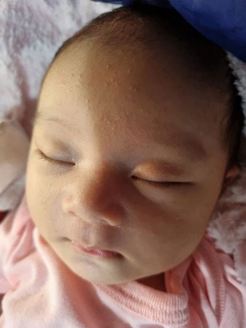 Beruntusan pada bayi