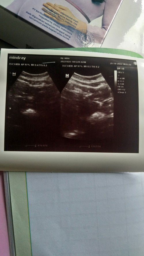 Hasil USG pas UK 5wk.