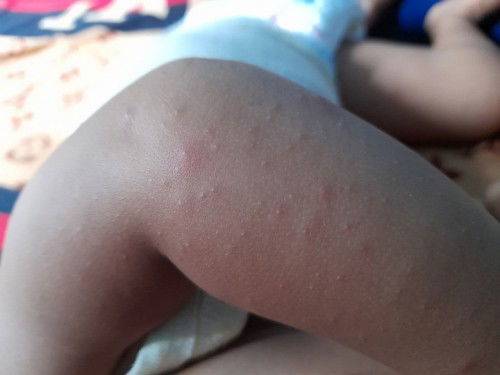 tangan bintik bruntusan