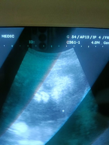 ไปอุนตร้าซาวมาแล้วค่ะลูกสาวแม่ 29สัปดาห์ วัดจากตัว แต่นับจากปจด27+6 แข็งเเรง ดิ้นเก่ง 1.4กก.