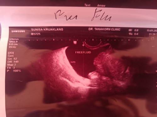 ใครเคยเป็นแบบนี้บ้างคะ ไม่พบถุงการตั้งครรภ์