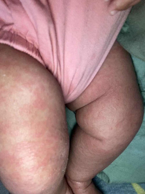 kulit bayi memerah seluruh badan