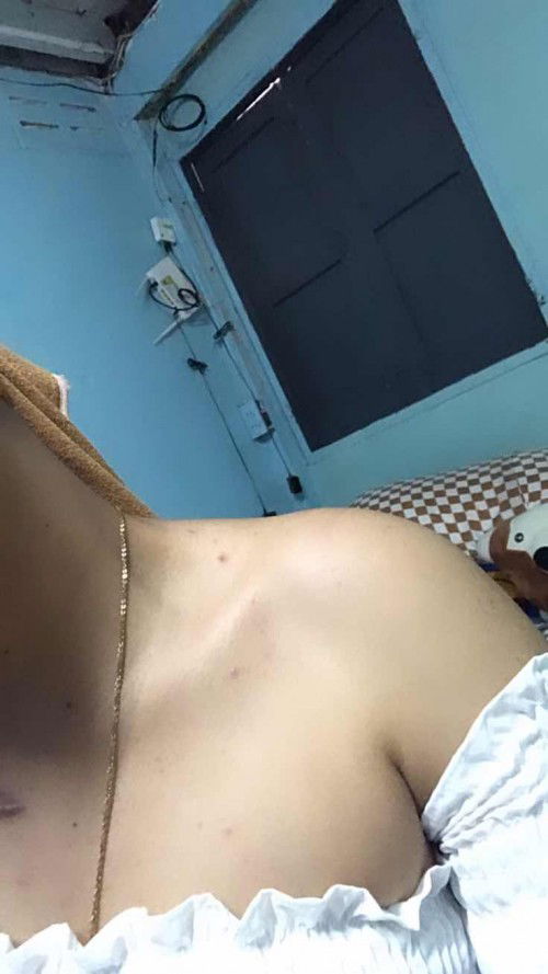 มีผื่น/สิวขึ้นตามตัว