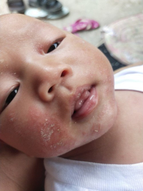 Allergy po ba to ?