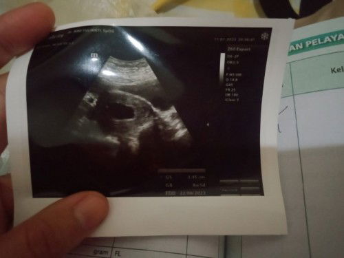Usia kehamilan 8 minggu masih belum terlihat janin