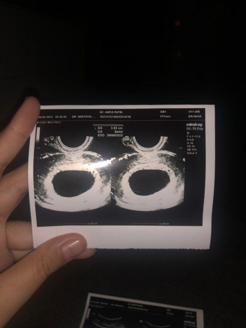 Usia kehamilan 8minggu 5hari tidak terlihat bakal janin