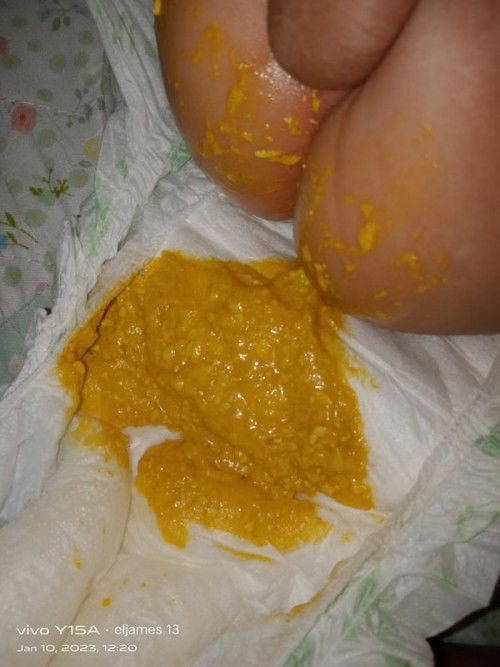 Normal lang ba sa baby na dilaw na parang kamatis tapos my plema nag antibiotics Po Siya