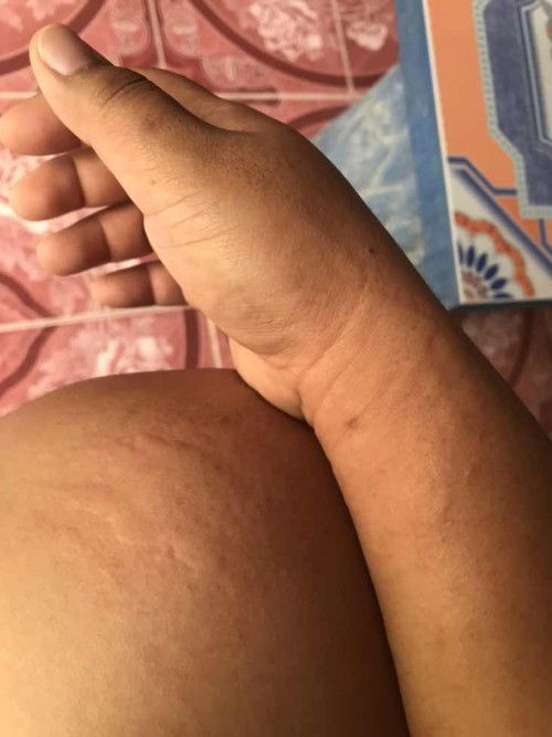 ท้องแรก ภูมิแพ้ผิวหนัง