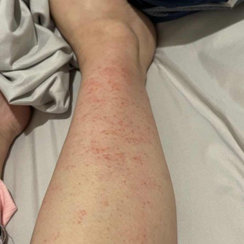 Dermatitis gatal2 / Eksim