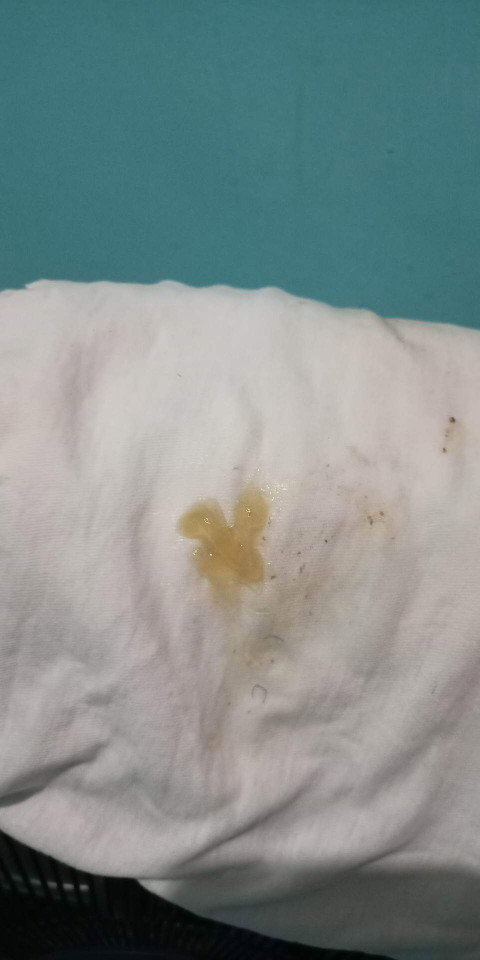 Mucus Plug