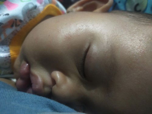 Bayi 6 bulan kena campak