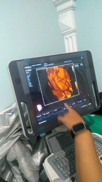 USG 18wk, yang sedikit membuat kecewa