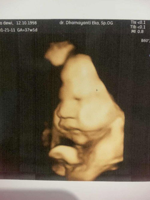 37week 5 day bb janin 3,456 dan ada lilitan 1 dileher