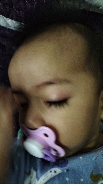 Mata bayi bengkak digigit serangga