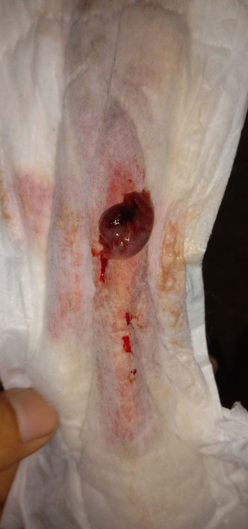 Keluar gumpalan darah