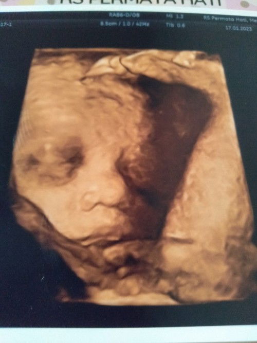 Hasil USG 28 week 3 day