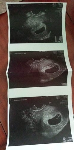 ไม่พบเสียงหัวใจของลูก