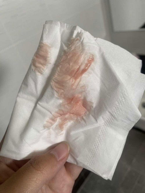 มูกเลือดแบบนี้ไปหาหมอได้เลยมั้ยคะ