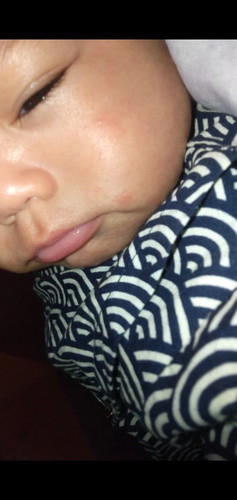 น้องมีผื่นที่คางกับเเก้มเเบบนี้เป็นผื่นอะไรค่ะอันตรายไหม