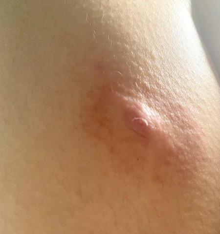 petechiae petechiae
