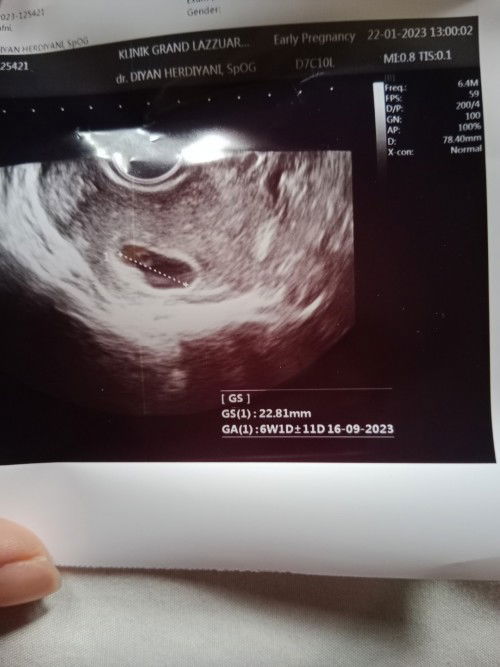 Hpht 8weeks, d USG 6week